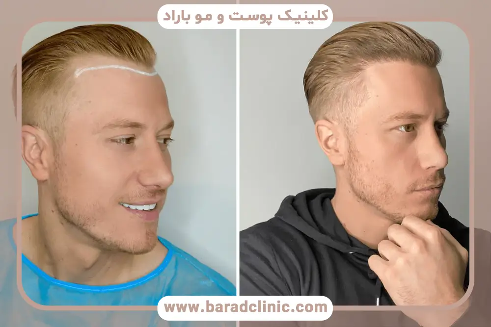 اهمیت بررسی نمونه کاشت مو 