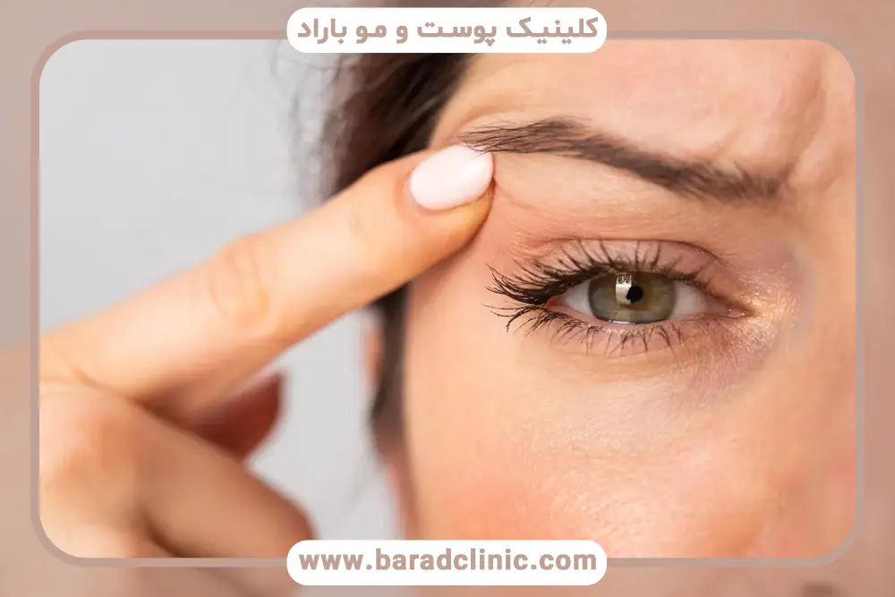 بلفاروپلاستی بدون جراحی غرب تهران چیست؟