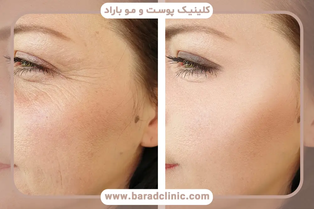 prp برای زیر چشم چیست؟ 