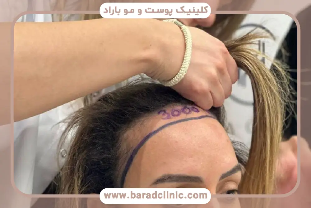 کاشت مو پیشانی زنان چیست؟