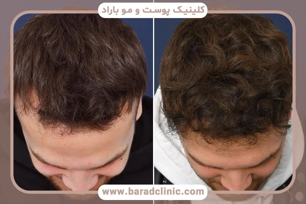 انتخاب کاشت مو کم پشت