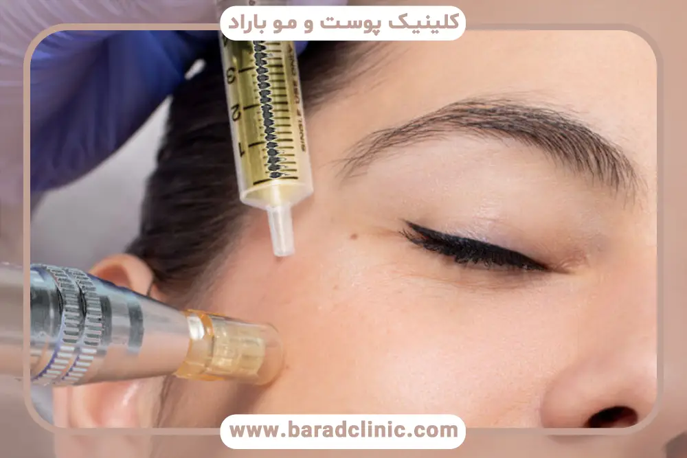 مزوتراپی دور چشم چگونه است؟ آشنایی با این روش