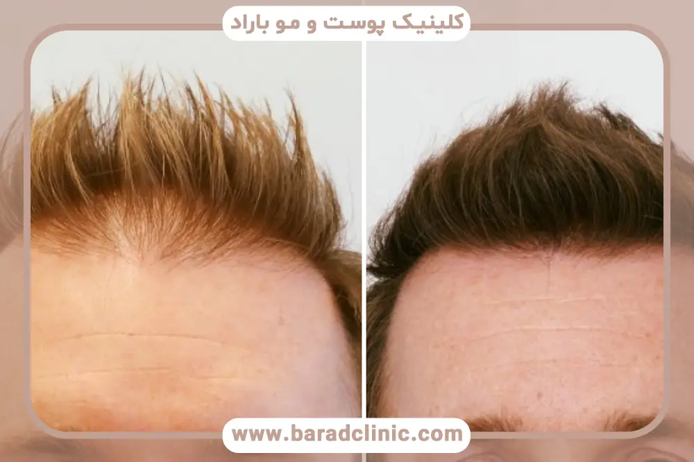 ضرورت عدم مصرف فیناستراید بعد کاشت مو