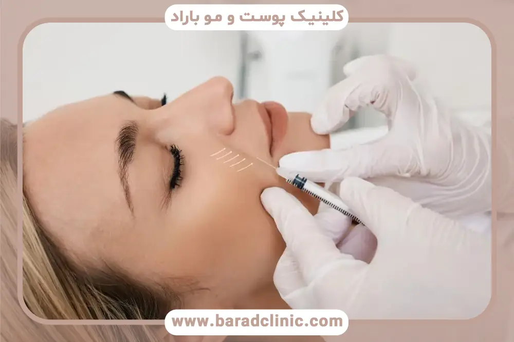 بوتاکس خط خنده چیست؟