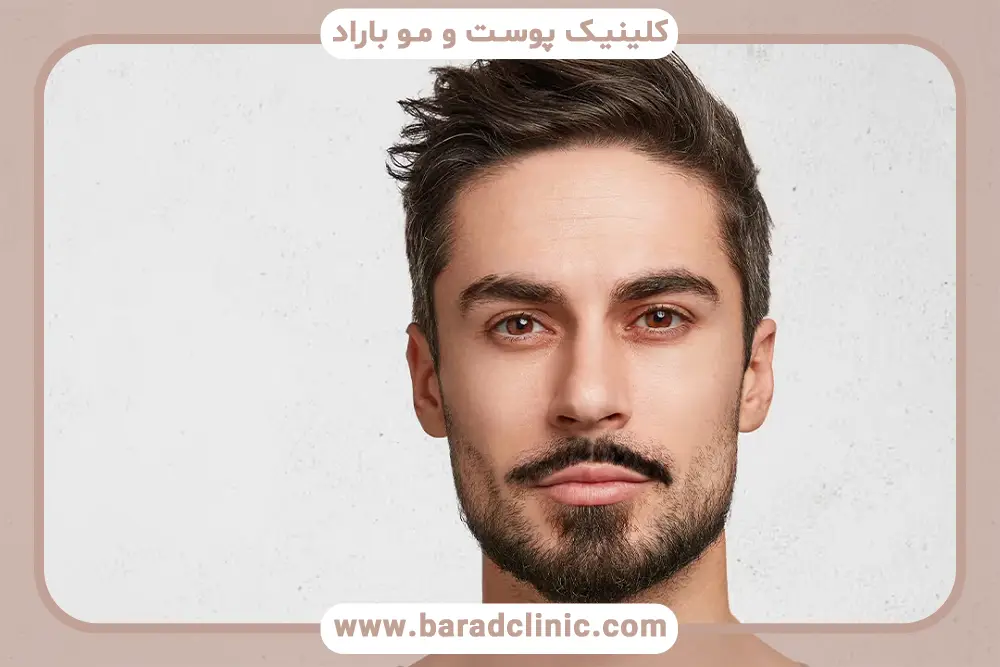 عوامل موثر بر هزینه کاشت سبیل در تهران