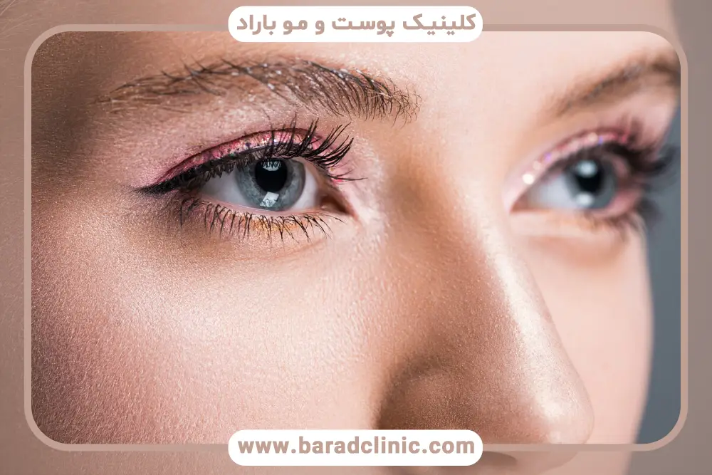 هزینه جراحی بلفاروپلاستی فوقانی غرب تهران چقدر است؟