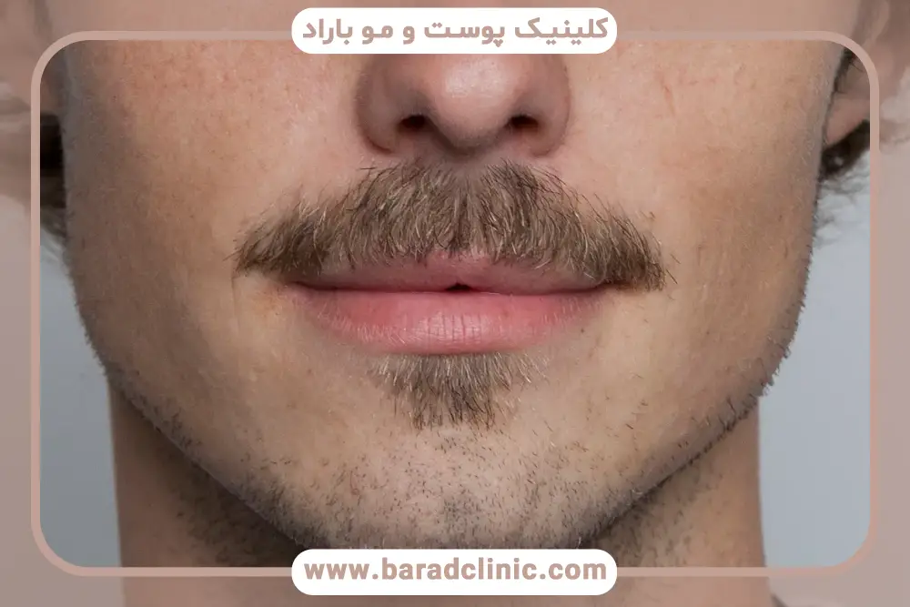 عوامل موثر بر هزینه کاشت سبیل در شمال تهران