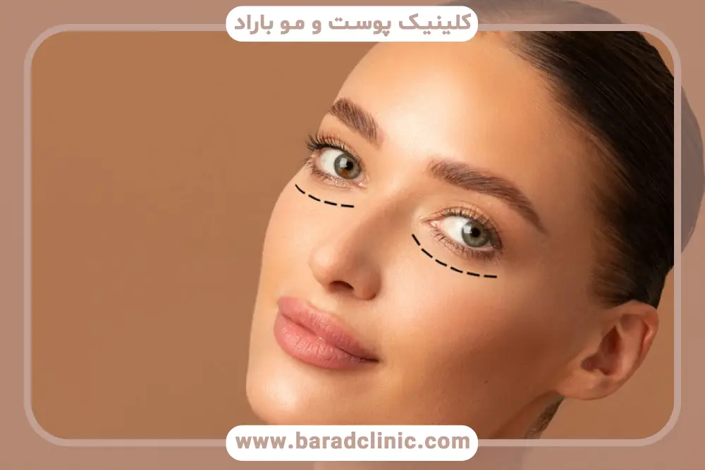 آشنایی با بلفاروپلاستی