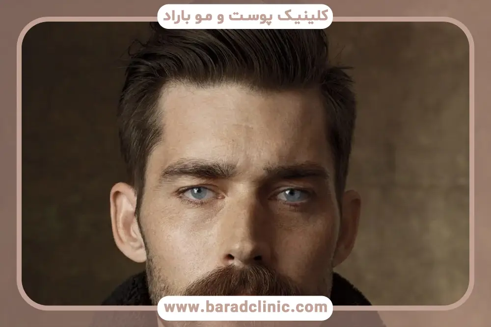 عوامل موثر بر هزینه کاشت سبیل در بهترین کلینیک تهران