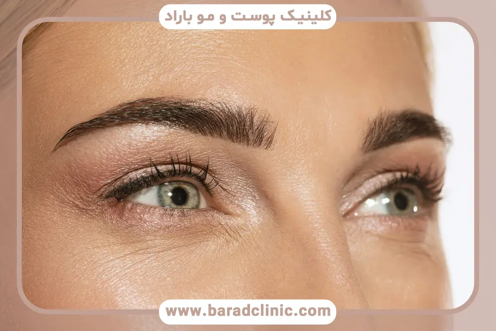 خدمات بلفاروپلاستی با لیزر تهران