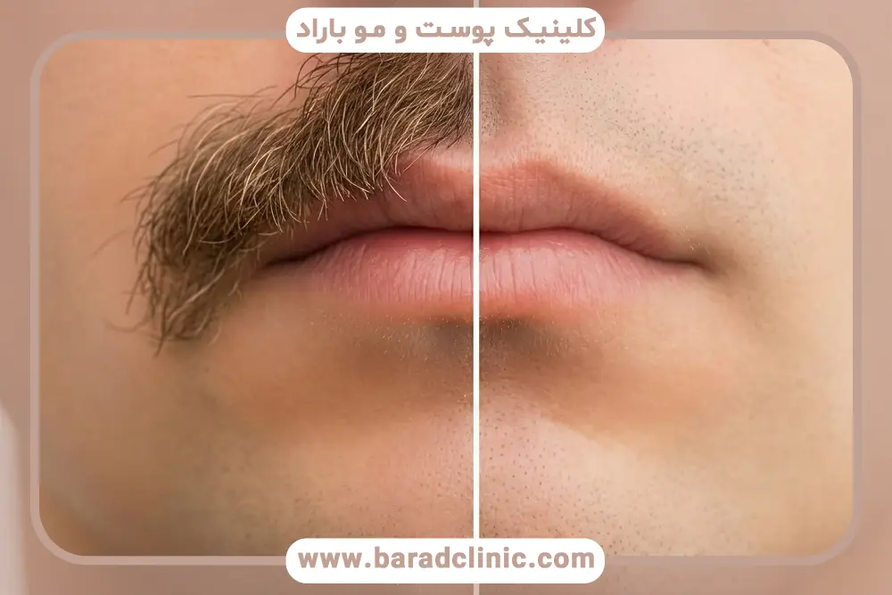 کاشت سبیل اقساطی چیست؟