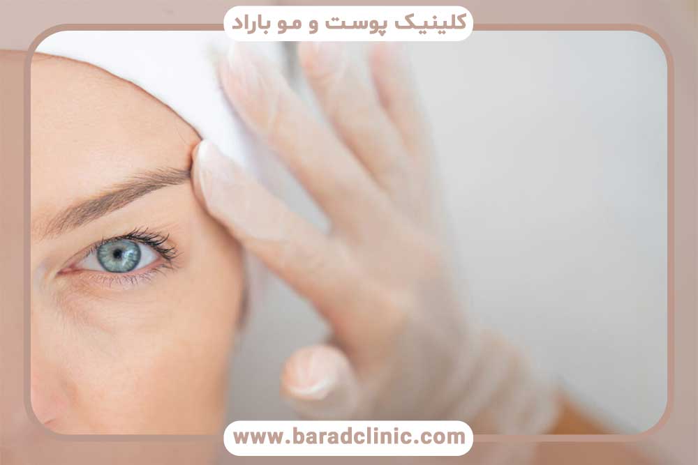 کاشت ابرو دخترانه برای صورت کشیده تهران