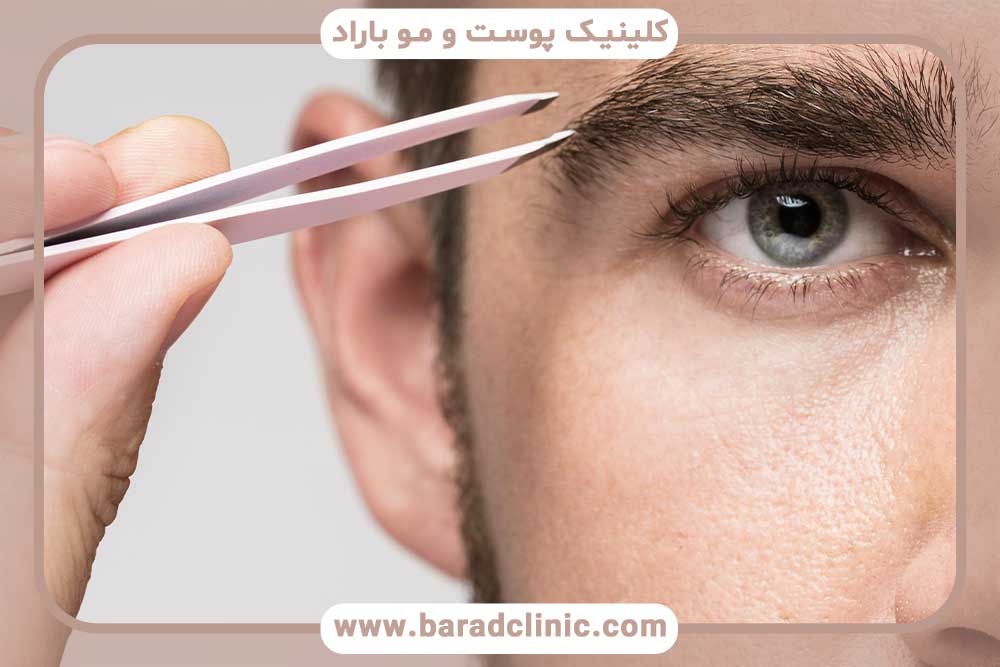 کاشت ابرو مردانه تهران