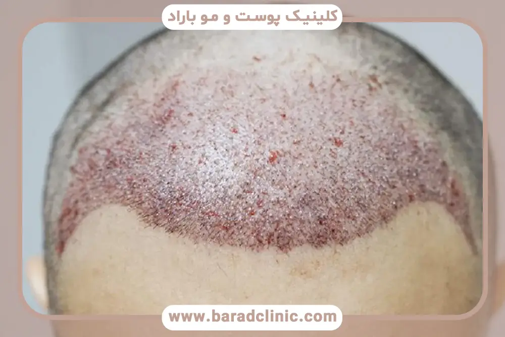 خشک شدن دلمه ها بعد از کاشت مو