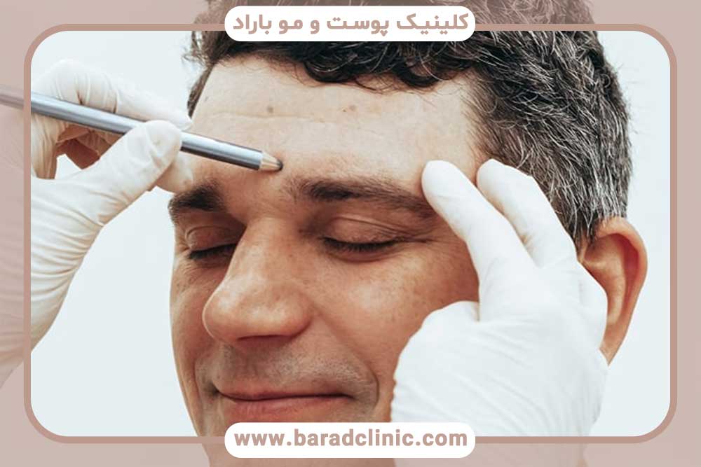 کاشت ابرو مردانه قسطی