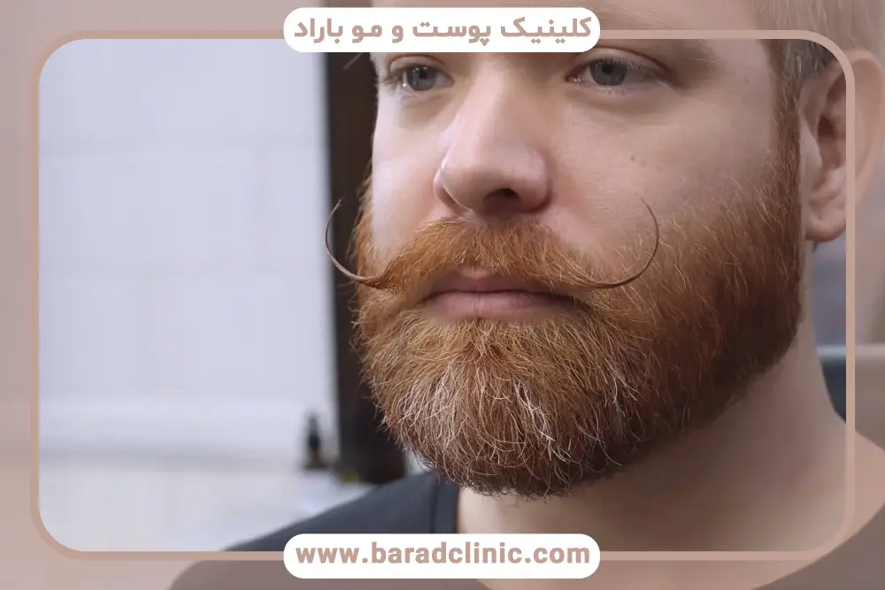 کاشت سبیل چیست؟