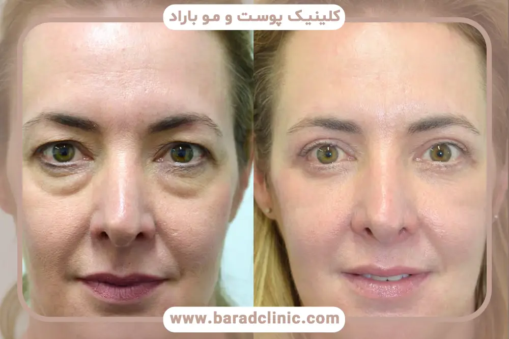 بررسی هزینه عمل بلفاروپلاستی تهران