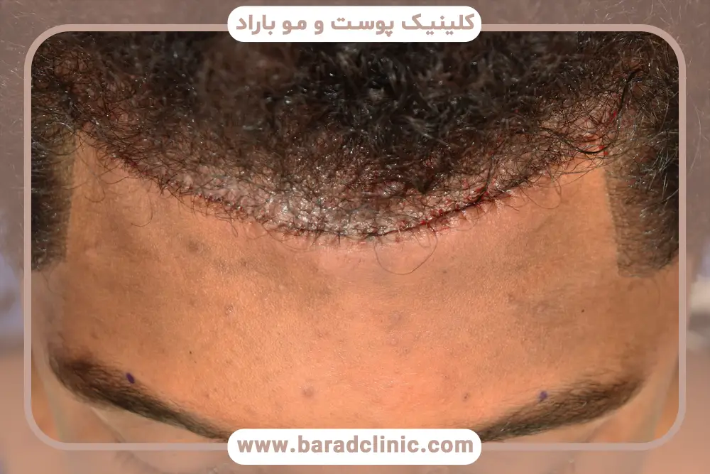 بهترین روش کاشت مو جلو پیشانی