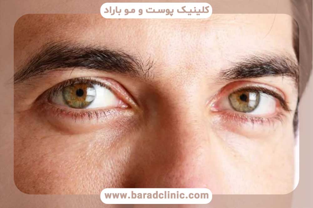 کاشت ابرو طبیعی مردانه تهران