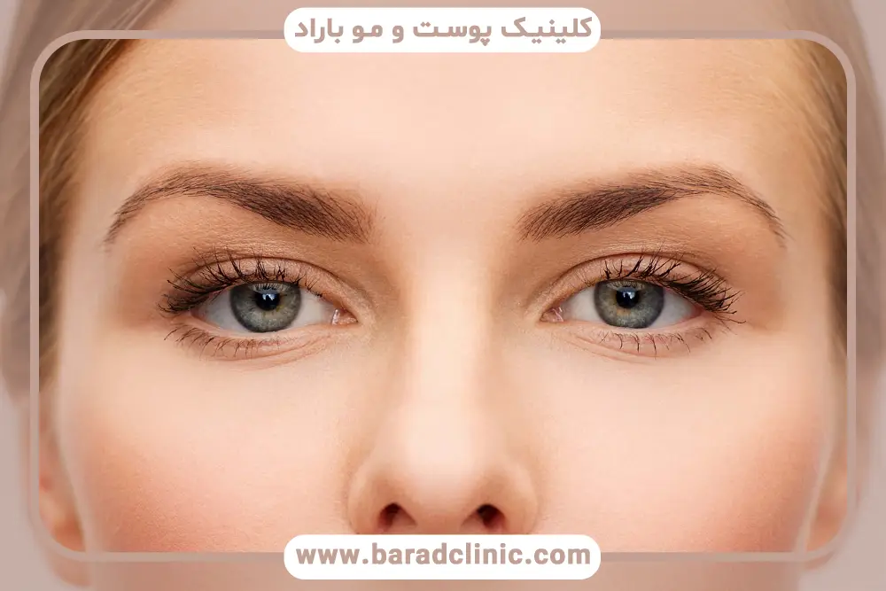 تاثیر مهارت جراح روی هزینه نهایی بلفاروپلاستی تحتانی