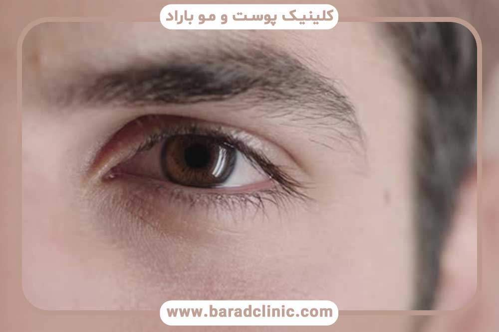 قیمت کاشت ابرو طبیعی مردانه