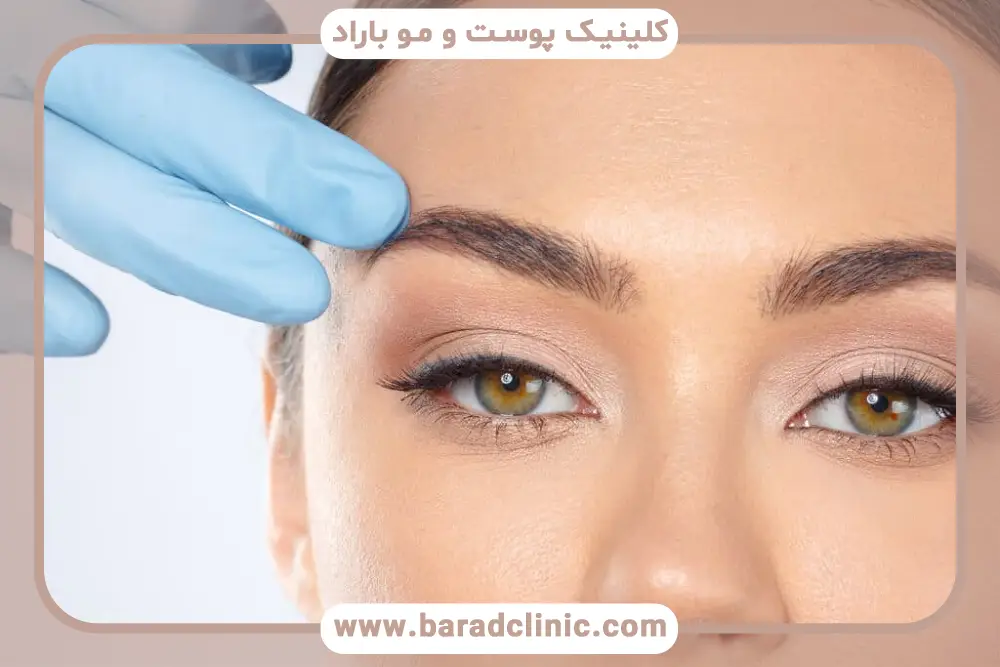 تصاویر واقعی بوتاکس ابرو قبل و بعد