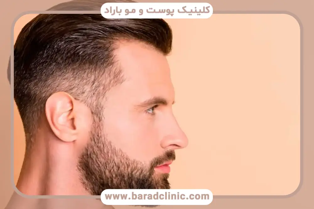 معیارهای انتخاب بانک مو مناسب برای کاشت ریش 