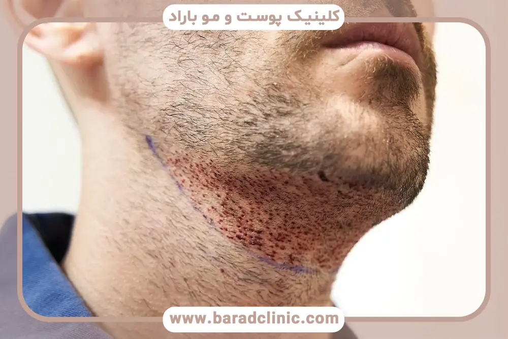 مزایای مزوتراپی ریش بعد از کاشت ریش