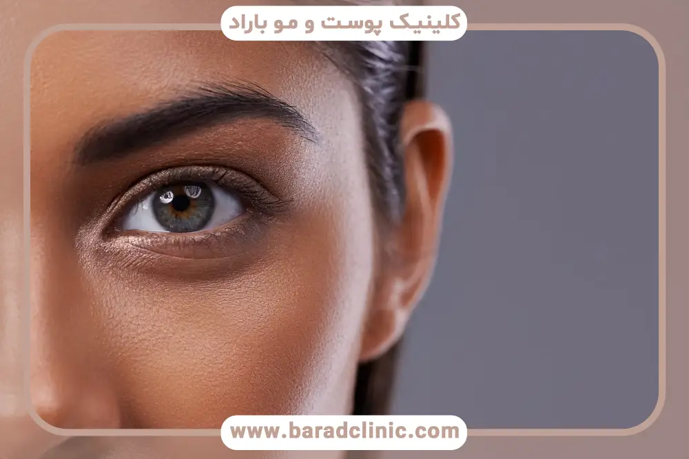 هزینه بلفاروپلاستی پلک پایین