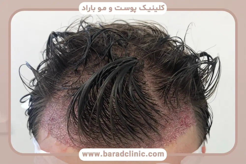 شوک لاس و ریزش مو بعد از کاشت مو