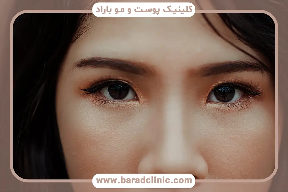 هزینه انواع روش بلفاروپلاستی تهران برای پلک بالا