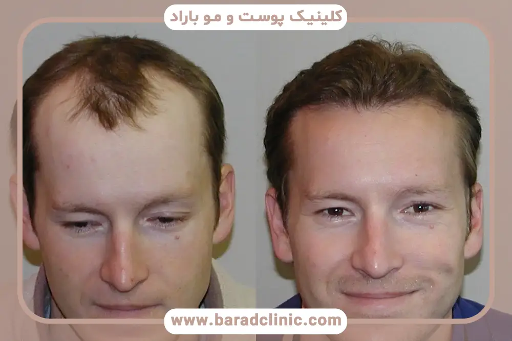 عفونت از مهم‌ترین عوارض کاشت مو در مردان