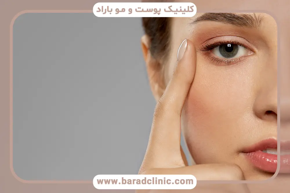 هزینه انواع روش بلفاروپلاستی غرب تهران برای پلک بالا و پایین