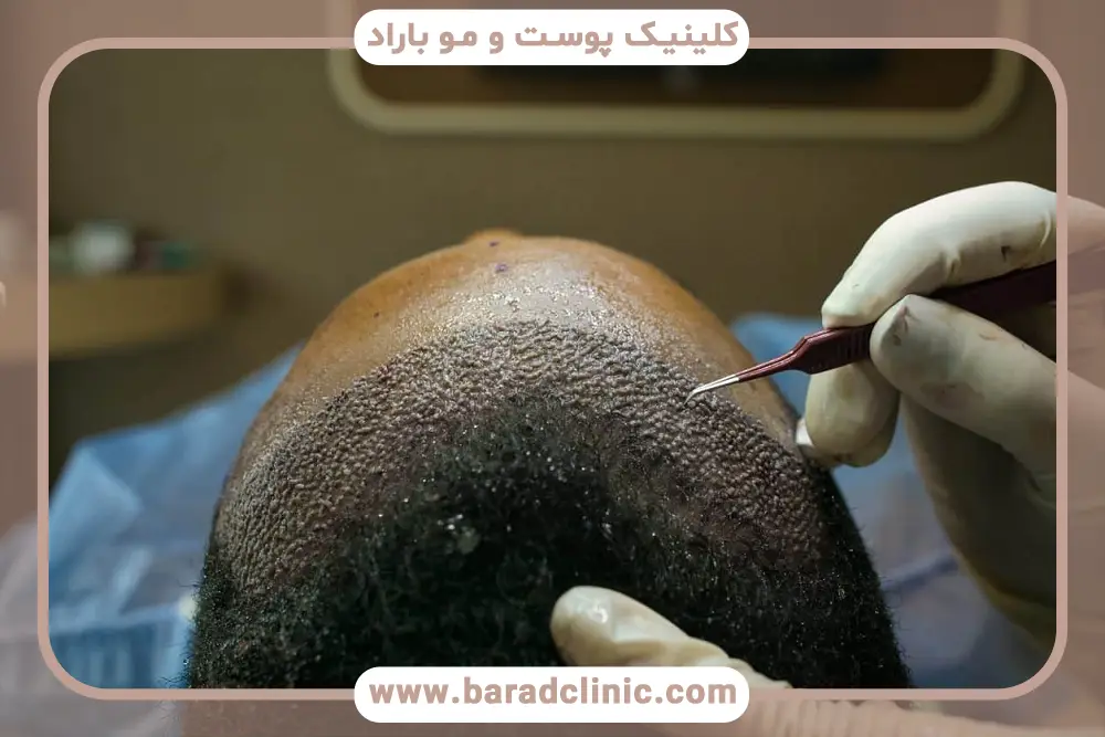 تصاویر واقعی از نمونه کاشت مو 