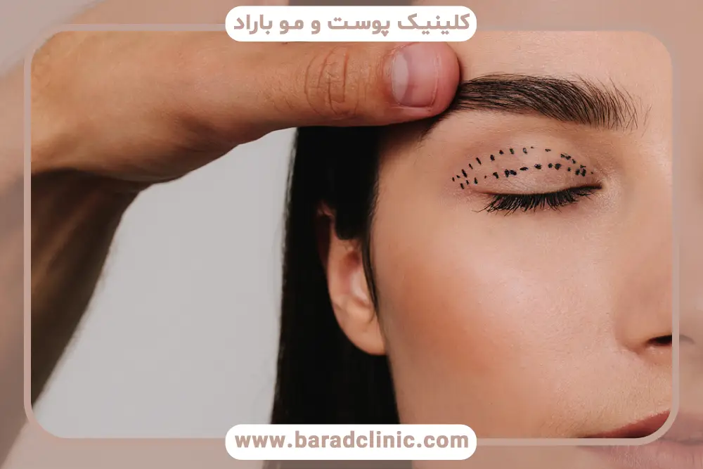 تفاوت هزینه جراحی بلفاروپلاستی فوقانی توسط جراح و پزشک عمومی