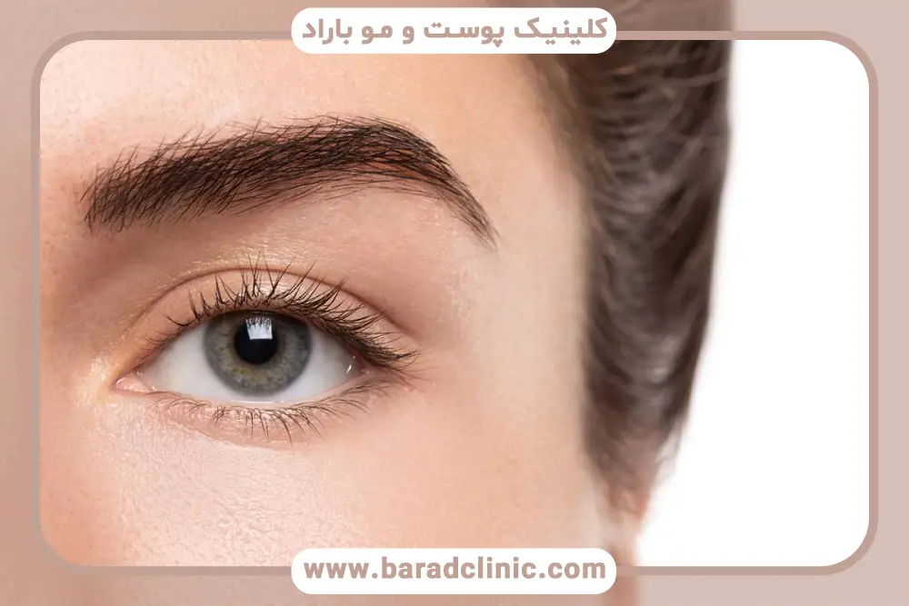 روشهای بلفاروپلاستی بدون جراحی غرب تهران