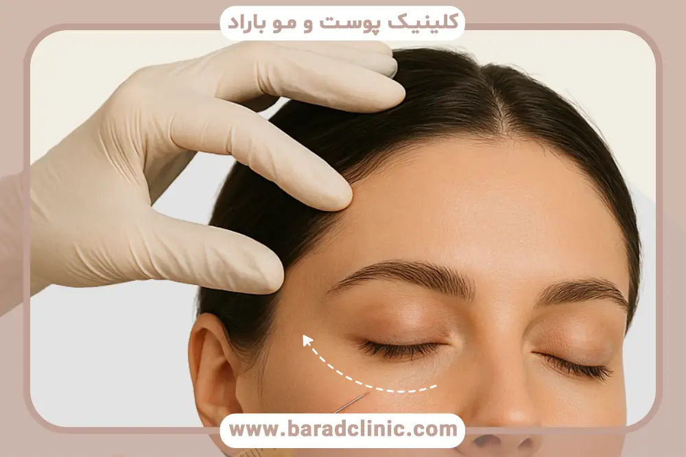 مراحل prp برای زیر چشم