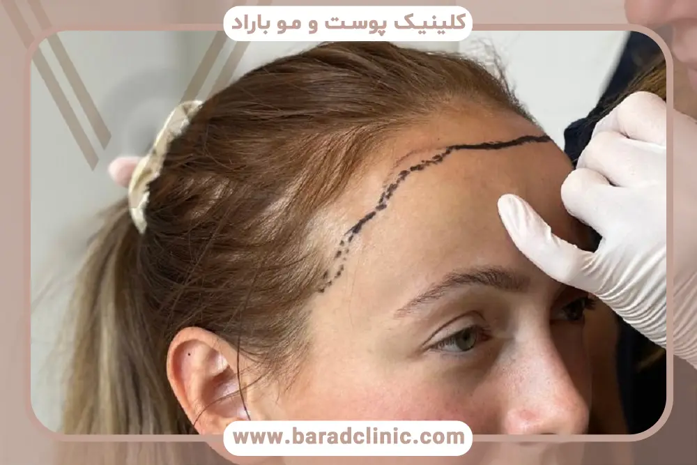 روش‌های کاشت مو پیشانی زنان 