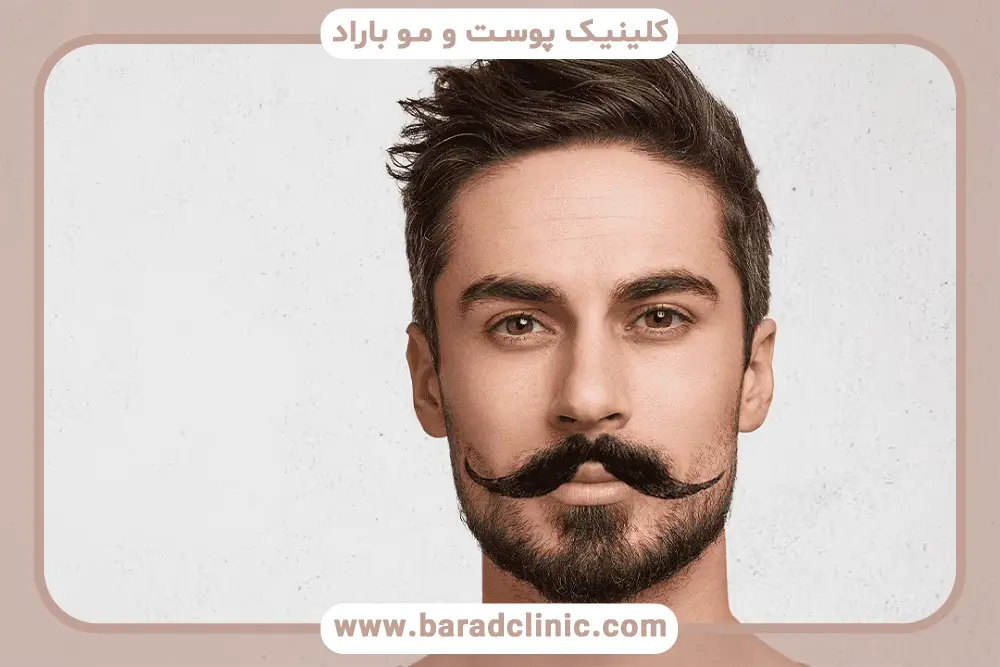 تاثیر روش کاشت روی ماندگاری کاشت سبیل