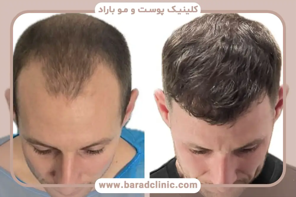 کاندیدای مناسب کاشت مو کم پشت