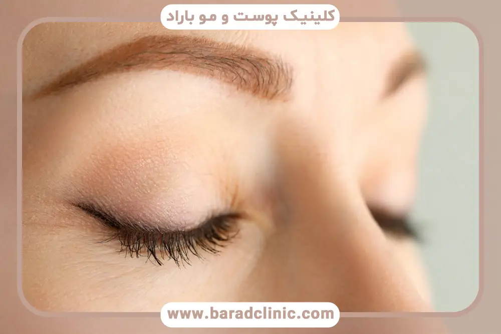 تاثیر جراح روی هزینه جراحی بلفاروپلاستی تحتانی تهران