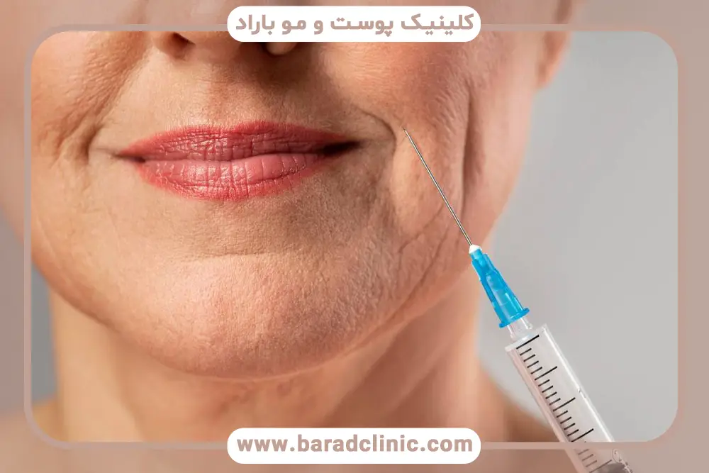 مراحل بوتاکس خط خنده