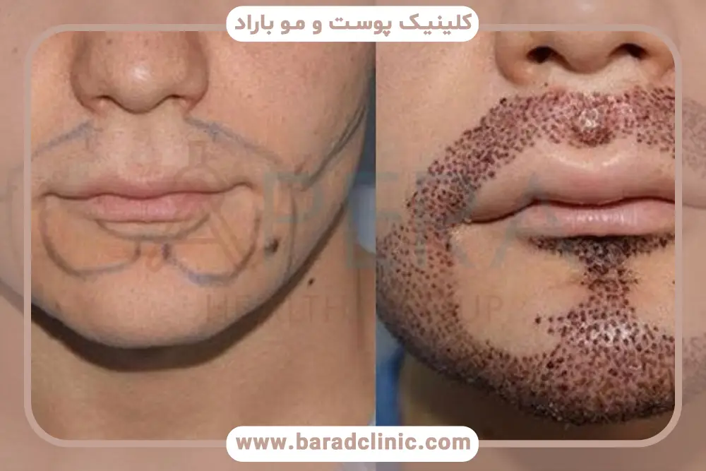 تفاوت‌های فردی در تعداد گرافت مو برای کاشت ریش