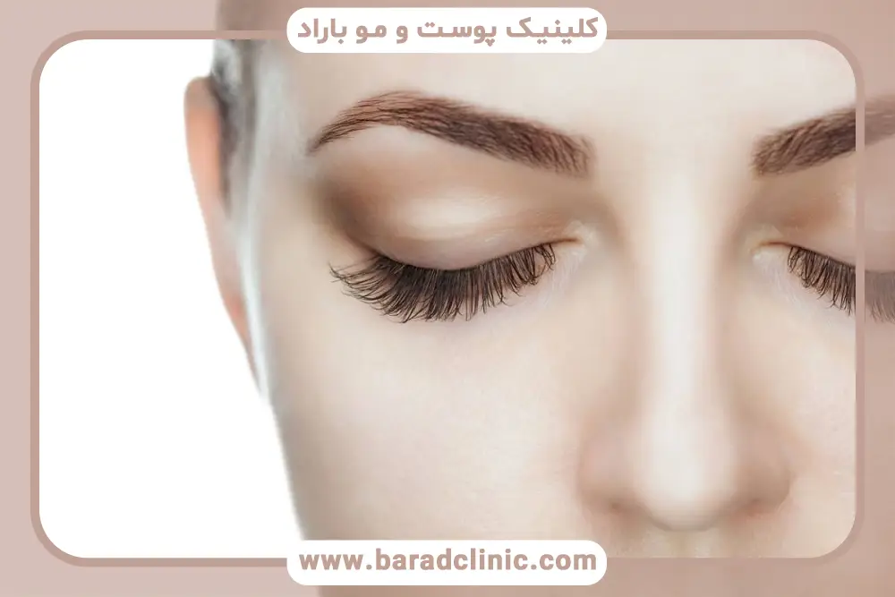 هزینه جراحی بلفاروپلاستی فوقانی غرب تهران با بیهوشی یا بیحسی