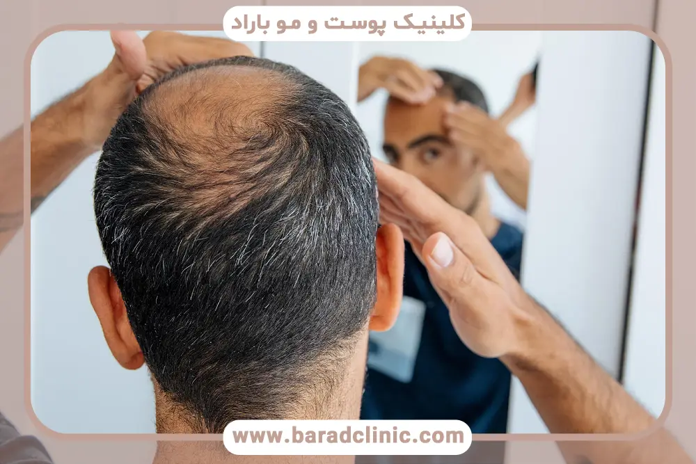 مواد تزریقی مزوتراپی سر