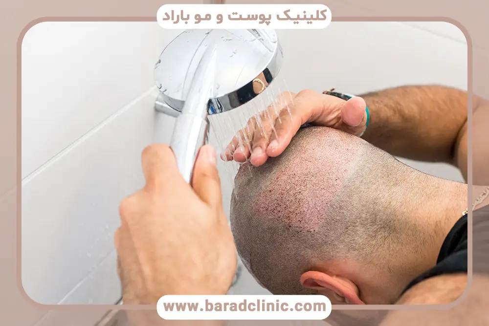 روش صحیح حمام بعد از کاشت مو