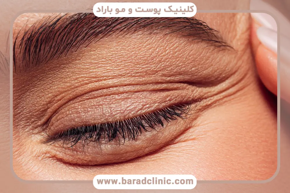 مراحل انجام بوتاکس زیر چشم