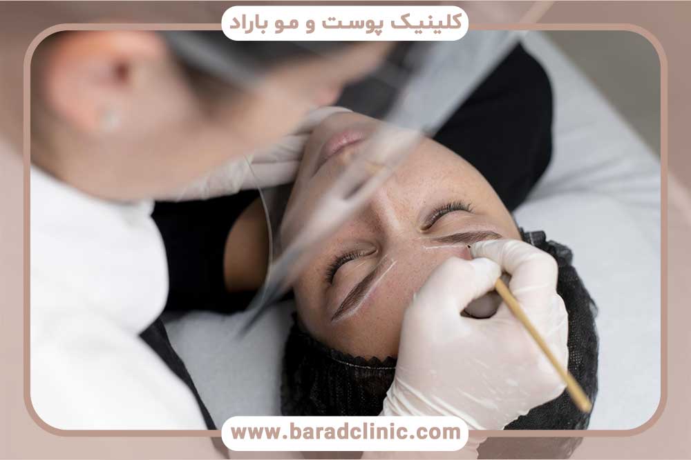 کاشت ابرو دخترانه برای صورت کشیده