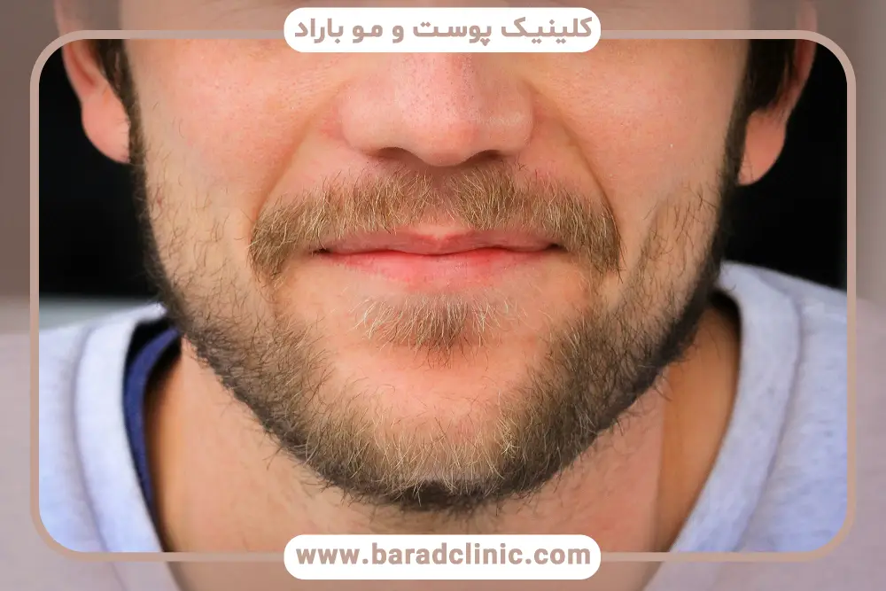 روند کاشت سبیل اقساطی