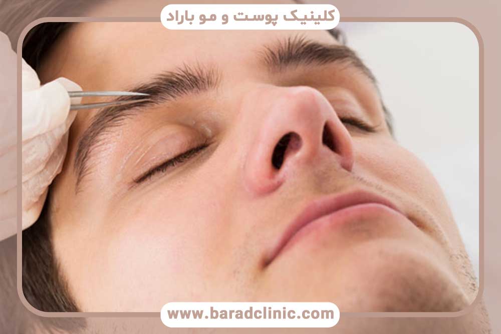 کاشت ابرو مردانه تهران